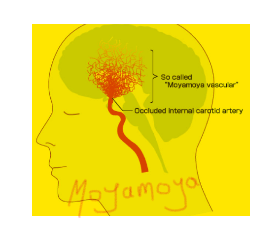 Moyamoya disease is a rare and complex cerebrovascular disorder characterized by the progressive narrowing of the arteries at the base of the brain. 